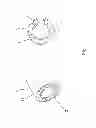 Fig. 09 - METHOD AND APPARATUS FOR DELIVERING CEMENT PASTE INTO A BONE CAVITY