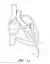 Fig. 03 - Suturing devices and methods for suturing an anatomic valve