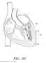 Fig. 62 - Suturing devices and methods for suturing an anatomic valve