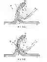 Fig. 13 - APPARATUS AND METHODS FOR FORMING AND SECURING GASTROINTESTINAL TISSUE FOLDS