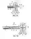 Fig. 17 - APPARATUS AND METHODS FOR FORMING AND SECURING GASTROINTESTINAL TISSUE FOLDS