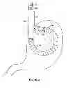 Fig. 34 - APPARATUS AND METHODS FOR FORMING AND SECURING GASTROINTESTINAL TISSUE FOLDS