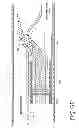 Fig. 14 - CATHETER SYSTEM FOR VASCULAR RE-ENTRY FROM A SUB-INTIMAL SPACE