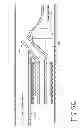 Fig. 15 - CATHETER SYSTEM FOR VASCULAR RE-ENTRY FROM A SUB-INTIMAL SPACE