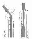 Fig. 19 - CATHETER SYSTEM FOR VASCULAR RE-ENTRY FROM A SUB-INTIMAL SPACE