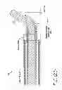 Fig. 22 - CATHETER SYSTEM FOR VASCULAR RE-ENTRY FROM A SUB-INTIMAL SPACE