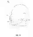 Fig. 23 - Methods for treating skin laxity