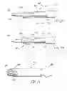Fig. 11 - Bodily Lumen Closure Apparatus and Method