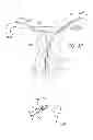 Fig. 12 - Bodily Lumen Closure Apparatus and Method