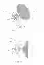 Fig. 02 - Method of implanting an adjustable occlusion device