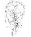 Fig. 02 - Embolic implant and method of use