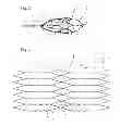 Fig. 04 - Embolic implant and method of use