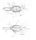 Fig. 11 - Embolic implant and method of use