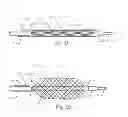 Fig. 12 - Embolic implant and method of use