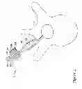 Fig. 06 - VERTEBRAL FIXATION SYSTEM