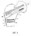 Fig. 02 - Hip fracture device with static locking mechanism allowing compression