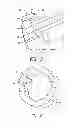 Fig. 04 - Hip fracture device with static locking mechanism allowing compression