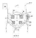 Fig. 11 - Transcutaneous stimulation method and system