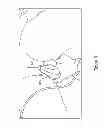 Fig. 06 - NON-SURGICAL METHOD FOR TIGHTENING BOTH EXTERNAL PUBIC AND INTERNAL VAGINAL TISSUES IN A SINGLE PROCEDURE