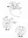 Fig. 08 - Intravascular electrode system and method