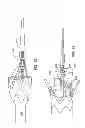 Fig. 06 - Delivery systems for delivering and deploying stent grafts