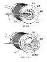 Fig. 50 - Delivery systems for delivering and deploying stent grafts