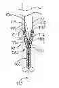Fig. 01 - Vessel bifurcation stent deployment system with zippered catheters