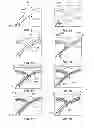 Fig. 07 - Vessel bifurcation stent deployment system with zippered catheters