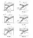 Fig. 08 - Vessel bifurcation stent deployment system with zippered catheters