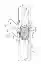 Fig. 05 - Rotating stent delivery system for side branch access and protection and method of using same