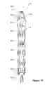 Fig. 09 - Assembly of stent grafts with diameter reducing ties