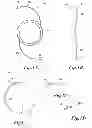 Fig. 02 - DEVICE AND METHOD FOR INTRAOCULAR DRUG DELIVERY