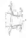 Fig. 03 - METHOD AND APPARATUS FOR INSERTING A FILLED PROSTHETIC BLADDER INTO A PATIENT