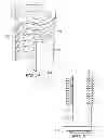 Fig. 14 - EXPANDABLE IMPLANT, INSTRUMENT, AND METHOD