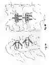 Fig. 06 - INTERVERTEBRAL IMPLANT WITH FIXATION GEOMETRY