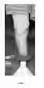 Fig. 04 - System to evaluate prosthetic sockets
