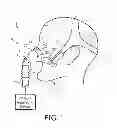 Fig. 02 - PATIENT INTERFACE ARRANGEMENT WITH ADJUSTABLE FOREHEAD SUPPORT