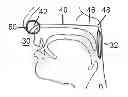 Fig. 01 - Devices And Methods For Treating Sleep Disordered Breathing