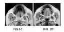Fig. 02 - Devices And Methods For Treating Sleep Disordered Breathing
