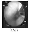 Fig. 08 - Devices And Methods For Treating Sleep Disordered Breathing