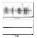 Fig. 09 - Devices And Methods For Treating Sleep Disordered Breathing