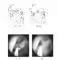 Fig. 14 - Devices And Methods For Treating Sleep Disordered Breathing