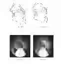 Fig. 15 - Devices And Methods For Treating Sleep Disordered Breathing