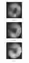 Fig. 16 - Devices And Methods For Treating Sleep Disordered Breathing