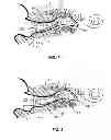 Fig. 02 - Dynamic pressure vent for canal hearing devices