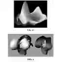 Fig. 04 - Methods for determining meniscal size and shape and for devising treatment