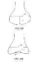 Fig. 08 - Methods for determining meniscal size and shape and for devising treatment