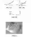 Fig. 09 - Methods for determining meniscal size and shape and for devising treatment
