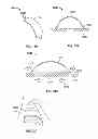 Fig. 07 - DEVICES AND METHODS FOR TREATING PAIN ASSOCIATED WITH TONSILLECTOMIES