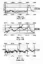 Fig. 04 - IDENTIFICATION OF BIOMARKERS FOR DETECTING PROSTATE CANCER
